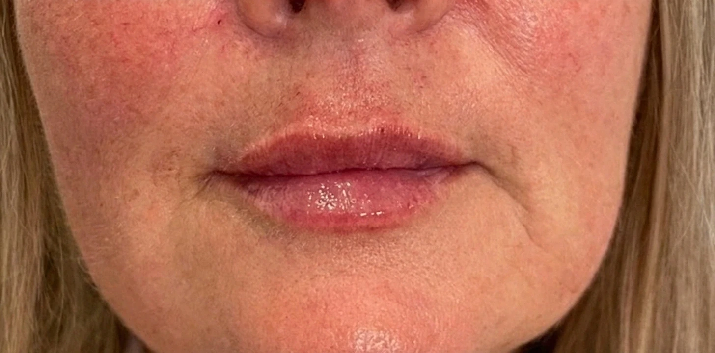 Lip Filler