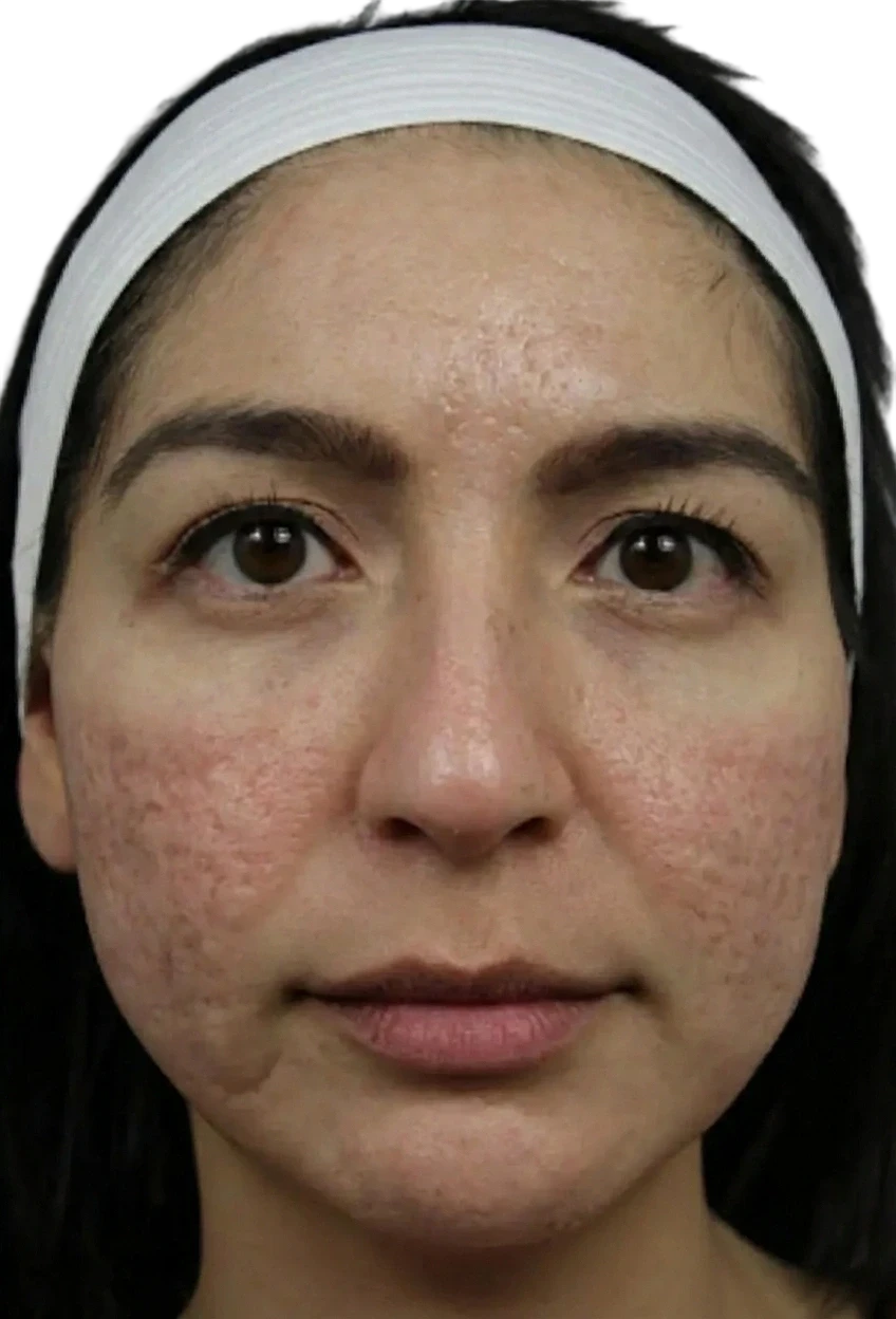 Microneedling before